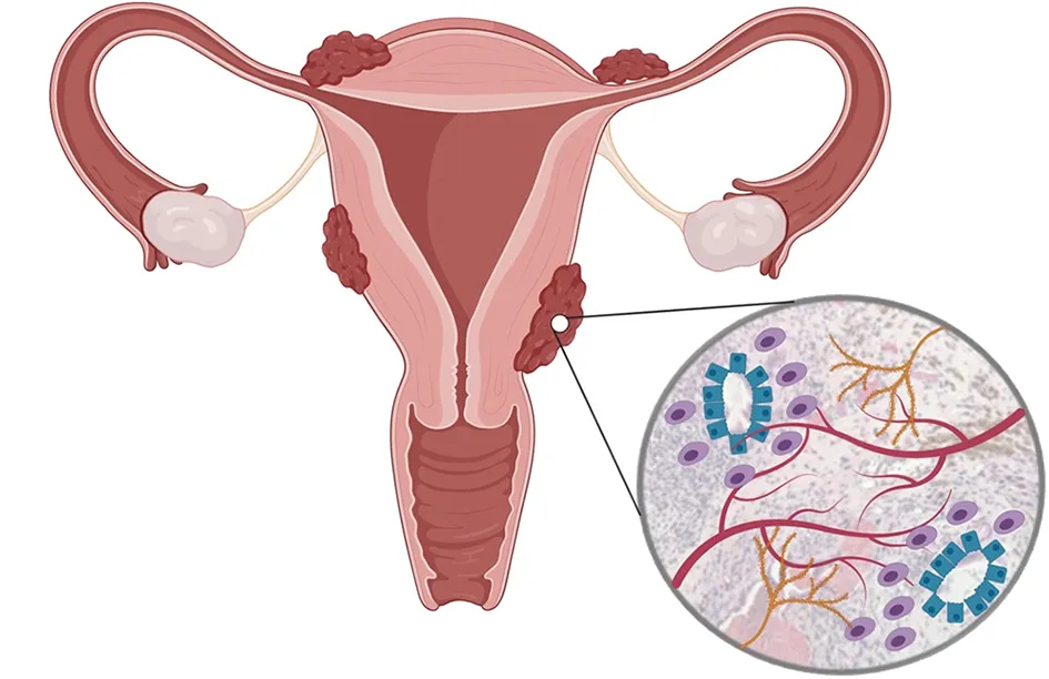 Endometriosis: The Silent Epidemic of Tissue Misplacement